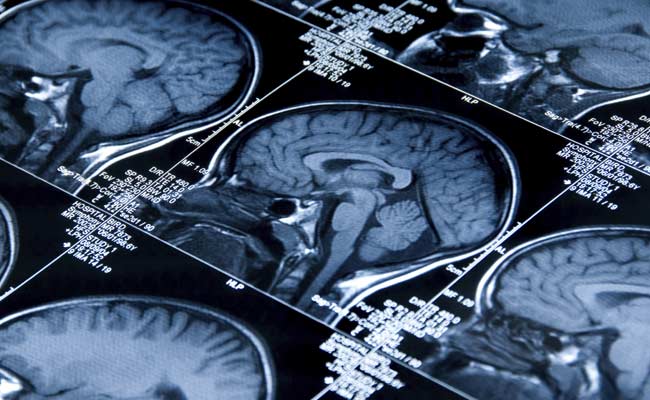 Tennis Ball-Size Bulge Removed From Elderly Woman’s Brain In Delhi
